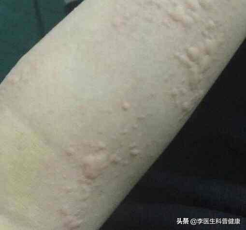 晚上發(fā)作的蕁麻疹，深入了解蕁麻疹夜發(fā)癥，蕁麻疹夜發(fā)癥深度解析
