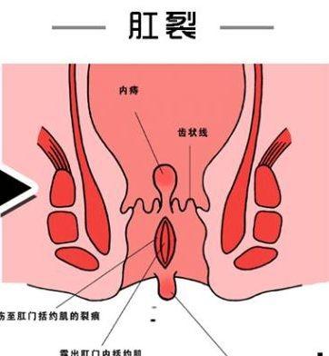 肛裂的最佳治療方法，全面解析與指導(dǎo)，全面解析指導(dǎo)，肛裂的最佳治療方法