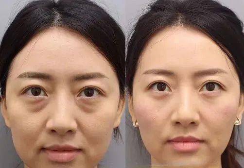眼袋皺紋的有效去除方法——打造年輕光彩的秘訣，眼袋皺紋去除秘籍，重塑青春光彩的秘訣