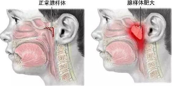 鼻塞嚴重無法睡覺，如何應(yīng)對讓人崩潰的困擾，鼻塞嚴重困擾睡眠，有效應(yīng)對方法助你安然入眠